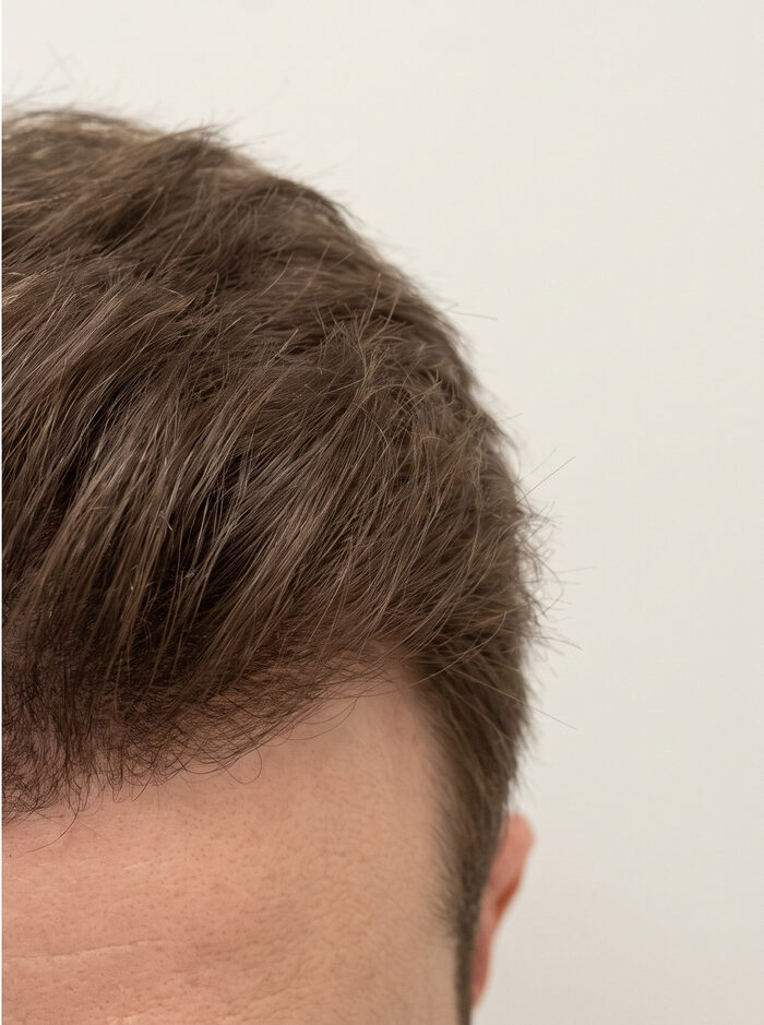 After Exosome Scalp Treatment