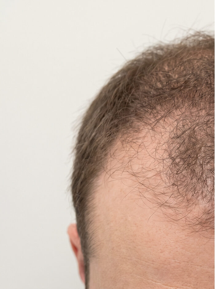 Before Exosome Scalp Treatment