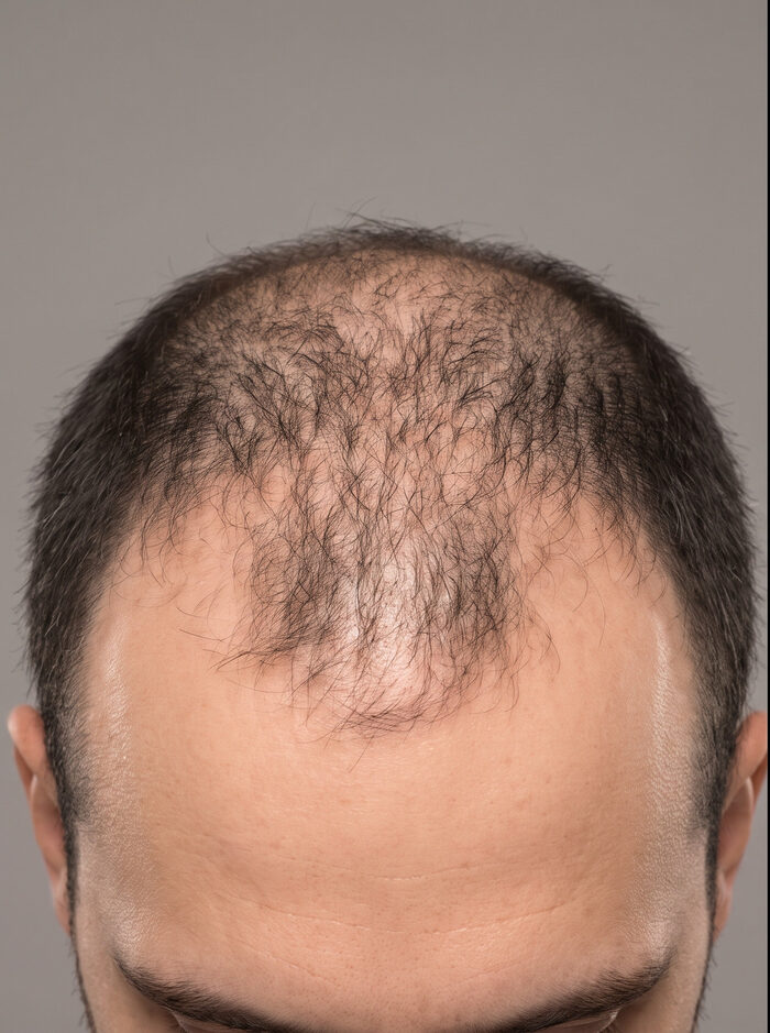 Before hair restoration